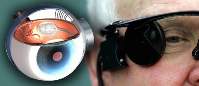 10 NHS pacientų gaus pažangiausias bionines akis