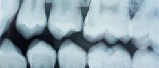 Tidak ada lagi tambalan yang menyakitkan! Terobosan gigi ini memperbaiki gigi berlubang “secara alami” menggunakan peptida